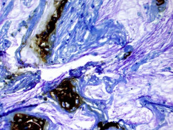 Bloquear el almacenamiento de colesterol podr&iacute;a detener el crecimiento de tumores pancre&aacute;ticos