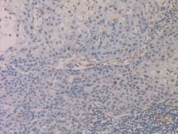 Descubren c&oacute;mo las c&eacute;lulas cancerosas que se extienden hasta los ganglios linf&aacute;ticos evitan la destrucci&oacute;n inmunitaria