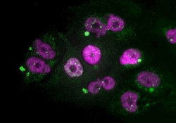 Descubren un nuevo objetivo farmacol&oacute;gico para el c&aacute;ncer de p&aacute;ncreas