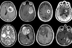 En Espa&ntilde;a se diagnostican m&aacute;s de 5.000 nuevos casos de tumores cerebrales cada a&ntilde;o