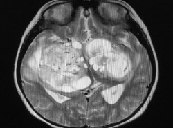 Estructuras descubiertas en pacientes con c&aacute;ncer cerebral pueden ayudar a combatir los tumores