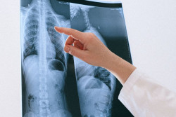 Identifican un biomarcador no invasivo para predecir el beneficio de la inmunoterapia en un tipo de c&aacute;ncer de pulm&oacute;n