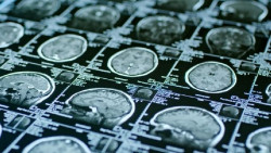 La acumulaci&oacute;n de hierro en el cerebro, relacionada con el deterioro cognitivo en pacientes con Alzheimer