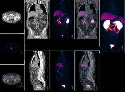La detecci&oacute;n selectiva del c&aacute;ncer de pr&oacute;stata podr&iacute;a prevenir una de cada seis muertes