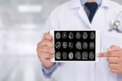 Los cient&iacute;ficos identifican las c&eacute;lulas cerebrales m&aacute;s vulnerables a la enfermedad de Alzheimer