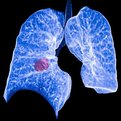 Los investigadores exploran un nuevo territorio en el tratamiento del c&aacute;ncer de pulm&oacute;n durante la pandemia
