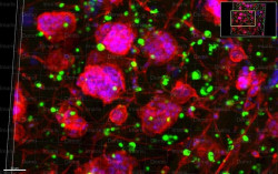 Modelos de tumores cultivados en laboratorio podr&iacute;an conducir a mejores tratamientos para el c&aacute;ncer de ovario