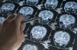 Un estudio se&ntilde;ala que una mol&eacute;cula logra "reprogramar" las defensas del cerebro frente al alzh&eacute;imer
