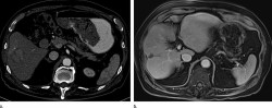 Un primer ensayo cl&iacute;nico en humanos demuestra una mejora en el tratamiento con radiaci&oacute;n del c&aacute;ncer de h&iacute;gado