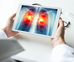 Una investigaci&oacute;n espa&ntilde;ola sobre c&aacute;ncer de pulm&oacute;n eleva un 20% la supervivencia y beneficiar&aacute; a 6.000 pacientes al a&ntilde;o