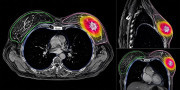 Una radioterapia de cinco d&iacute;as y m&iacute;nimo volumen muestra resultados favorables en pacientes con c&aacute;ncer de mama precoz
