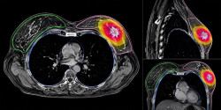 Una radioterapia de cinco d&iacute;as y m&iacute;nimo volumen muestra resultados favorables en pacientes con c&aacute;ncer de mama precoz